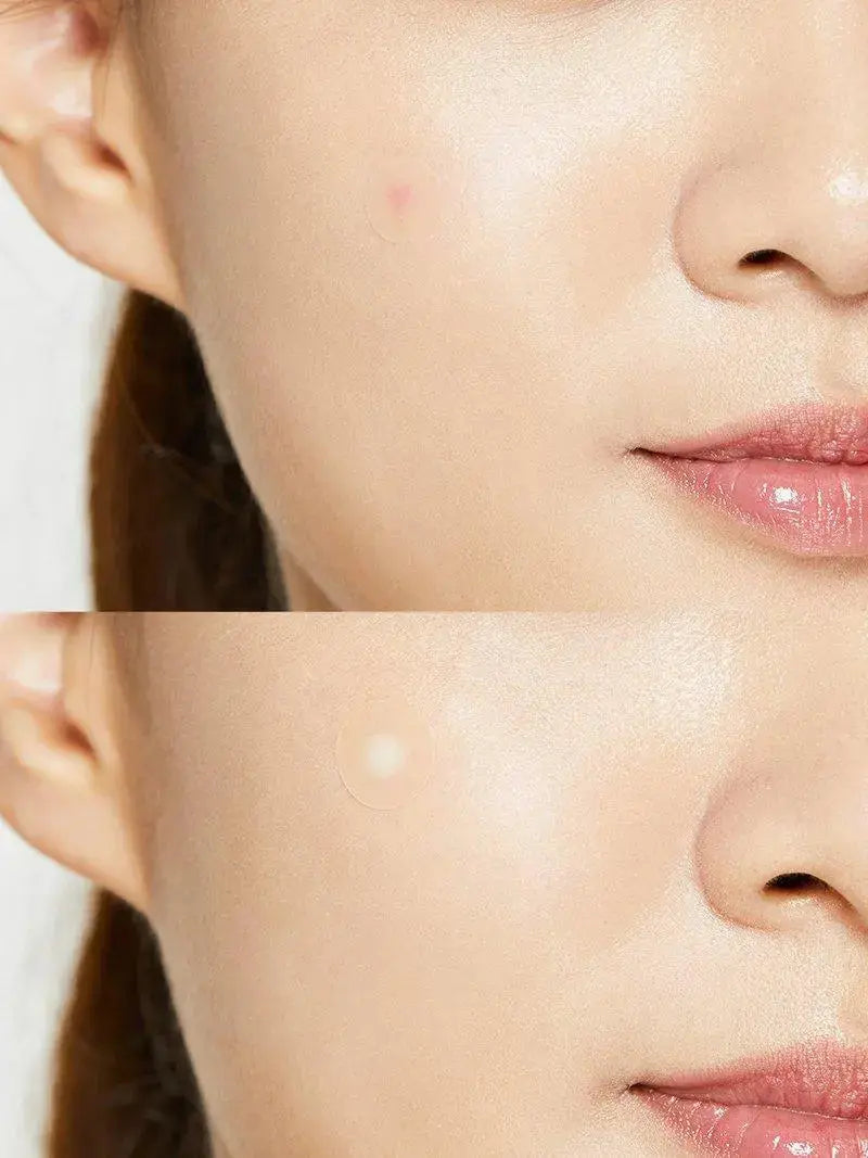 Pimple patch: hoe werkt het en wanneer gebruik je 'm?