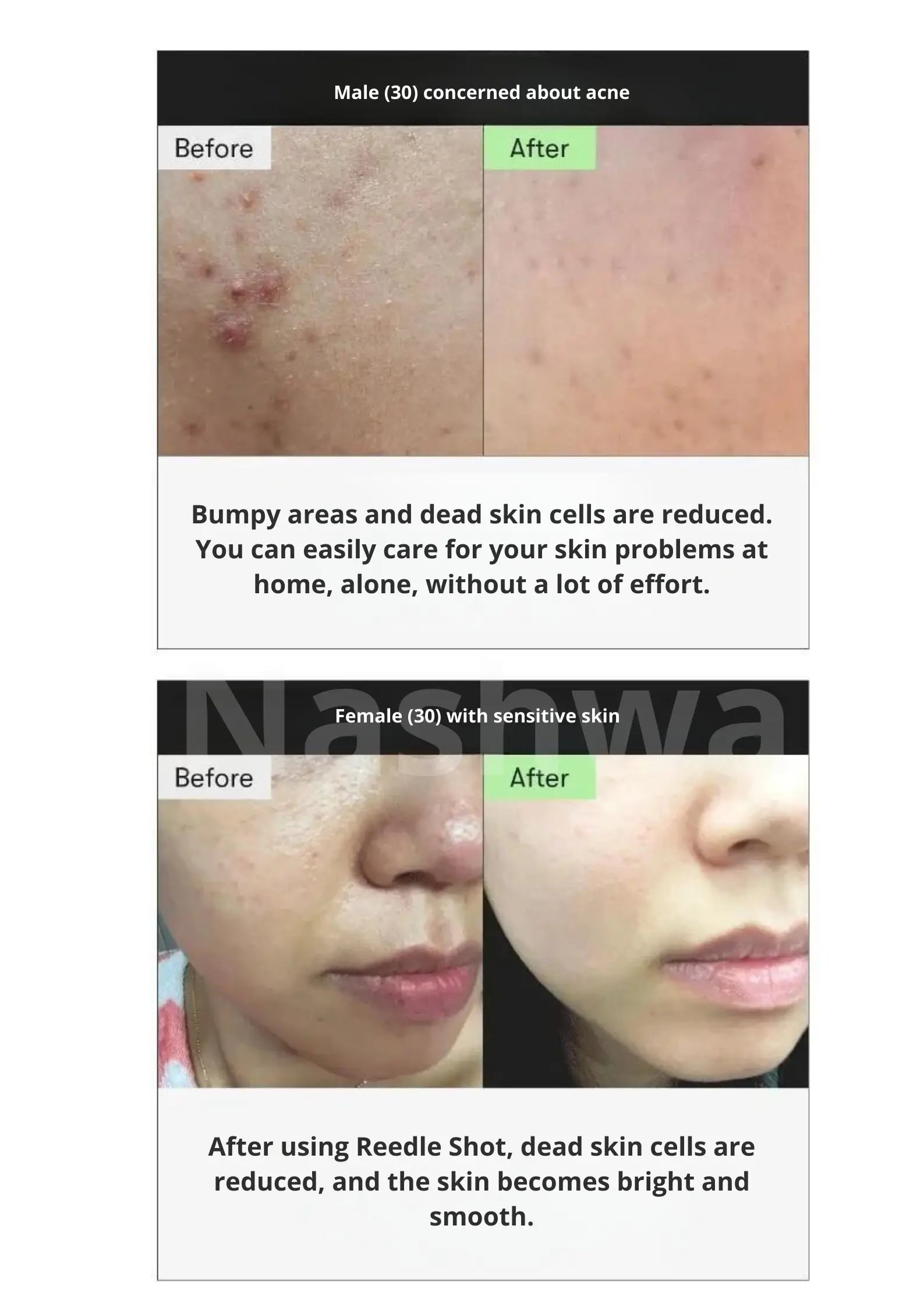 VT-cosmetis - VT Reedle shot 300 - korean skincare - nashwa