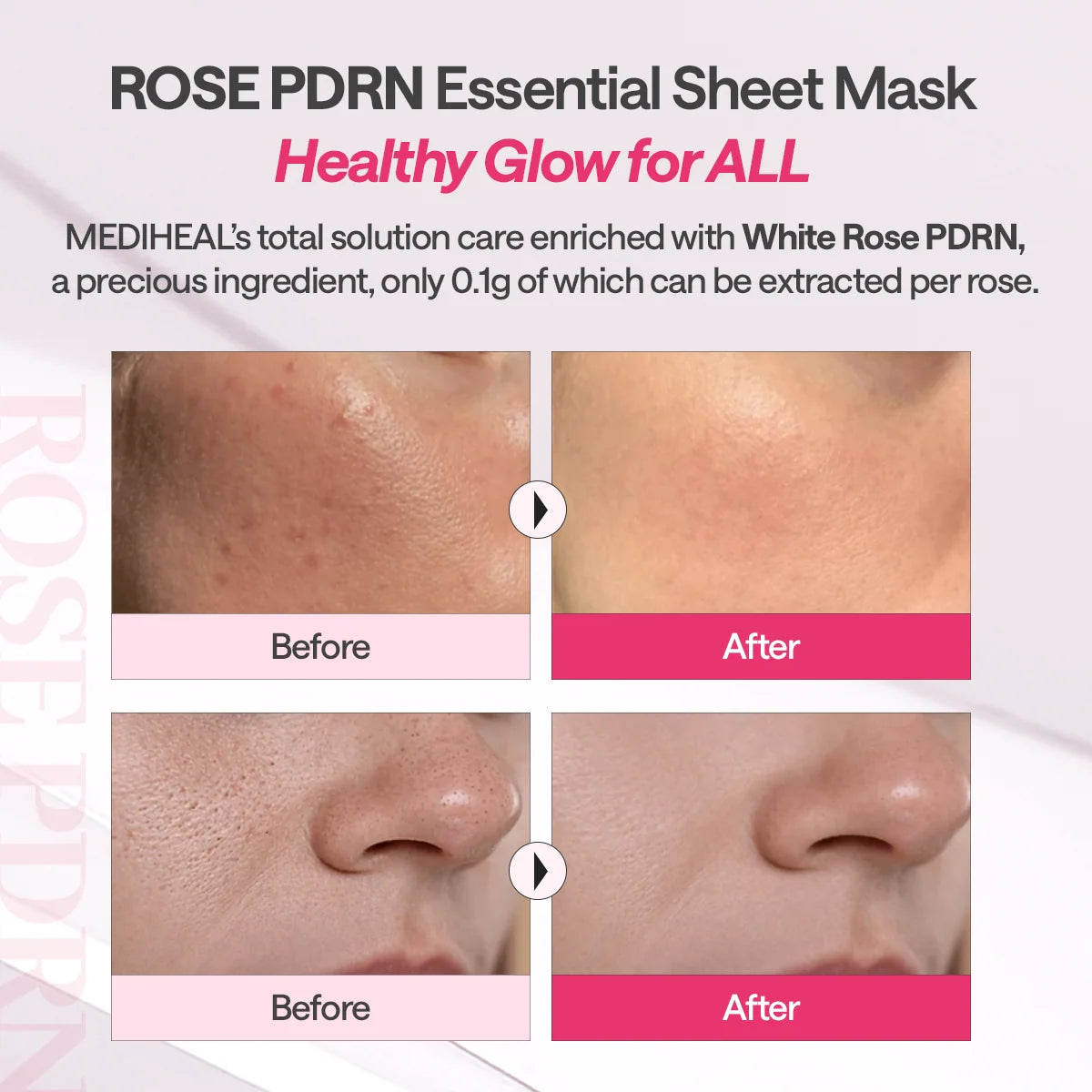 Voor en na foto's van de huid na gebruik van het Mediheal Essential Mask Rose PDRN
