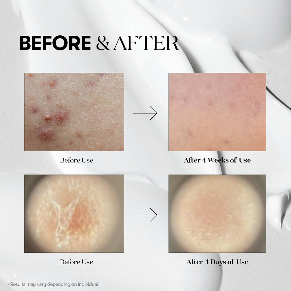 VT Cosmetics VT Reedle Shot 100, huid voor en na 4 weken volgens het merk